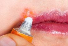 What Is Genital Herpes? Symptoms, Causes, Diagnosis, Treatment, and Prevention