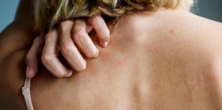 What Is Impetigo? Symptoms, Causes, Diagnosis, Treatment, and Prevention