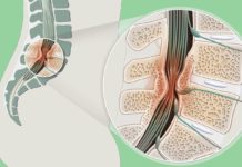 What Is Spinal Stenosis? Symptoms, Causes, Diagnosis, Treatment, and Prevention