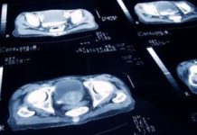 Brachytherapy and Fertility