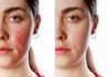 How to Get Rid of Rosacea: 7 Rosacea Remedies That Work