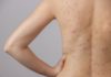 How to Get Rid of Back Acne: 11 Tips and Remedies that Work