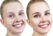 How to Get Rid of Acne Overnight: 12 Remedies that Work