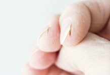 Severely Cracked Hands? 8 Tips & Remedies for Fast Relief