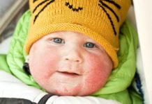 Natural eczema treatment: 7 natural ways to treat eczema that work!