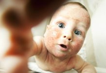 7 eczema remedies that work