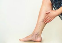 How to Get Rid of Varicose Veins: 9 Home Remedies That Work