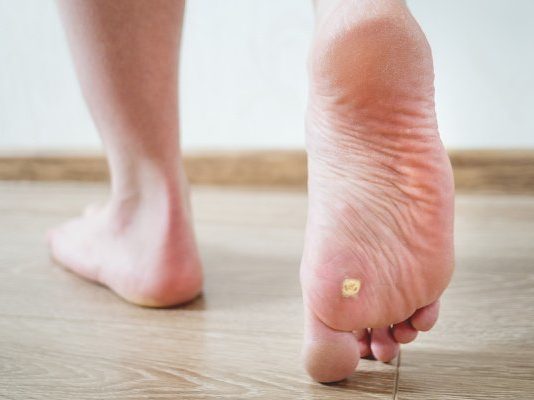 Home Remedies that Work: 7 Natural Treatments for Plantar Warts