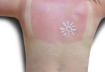 Too Much Sun! 8 Natural Sunburn Remedies That Work Fast