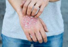 How to Get Rid of Psoriasis: 9 Tips and Remedies to Try