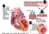 What Are Calcium Channel Blockers?
