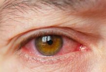 What Are Cataracts? Symptoms, Causes, Diagnosis, Treatment, and Prevention