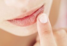 What Are Chapped Lips? Symptoms, Causes, Diagnosis, Treatment, and Prevention