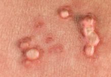 What Are Genital Warts? Symptoms, Causes, Diagnosis, Treatment, and Prevention