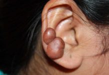 What Are Keloids? Symptoms, Causes, Diagnosis, Treatment, and Prevention