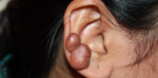 What Are Keloids? Symptoms, Causes, Diagnosis, Treatment, and Prevention