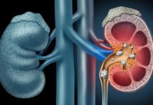 What Are Kidney Stones? Symptoms, Causes, Diagnosis, Treatment, and Prevention