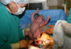 What Is a C-Section?