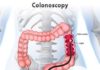 What Is a Colonoscopy?