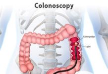 What Is a Colonoscopy?