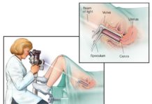 What Is a Colposcopy?