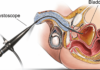 What Is a Cystoscopy?