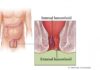 What Is a Hemorrhoidectomy?