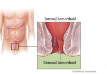 What Is a Hemorrhoidectomy?