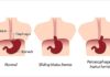 What Is a Hiatal Hernia? Symptoms, Causes, Diagnosis, Treatment, and Prevention
