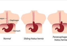 What Is a Hiatal Hernia? Symptoms, Causes, Diagnosis, Treatment, and Prevention