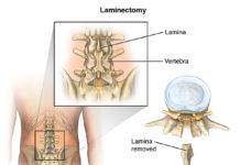What is a Laminectomy?