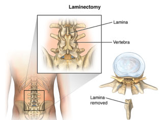 What is a Laminectomy?