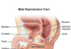What Is a Prostatectomy?