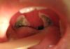What Is a Tonsillectomy?