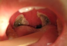 What Is a Tonsillectomy?