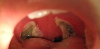 What Is a Tonsillectomy?