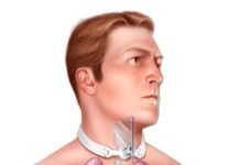 What Is a Tracheostomy?
