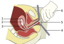 What Is an Abortion?