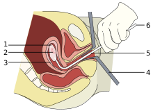 What Is an Abortion?