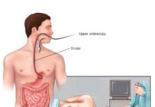 What Is an Endoscopy?