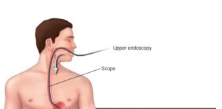 What Is an Endoscopy?
