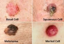 What Is an Epidermoid Cyst? Symptoms, Causes, Diagnosis, Treatment, and Prevention