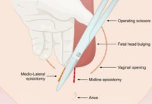 What Is an Episiotomy?