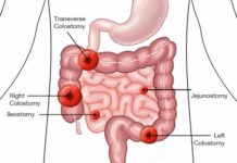 What Is an Ileostomy?