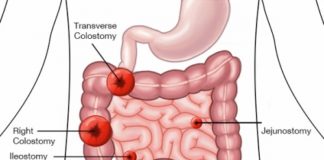 What Is an Ileostomy?