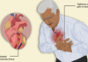 What Is Angina? Symptoms, Causes, Diagnosis, Treatment, and Prevention
