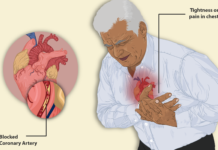 What Is Angina? Symptoms, Causes, Diagnosis, Treatment, and Prevention