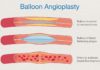 What Is Angioplasty?