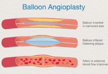 What Is Angioplasty?