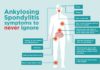 What Is Ankylosing Spondylitis (AS)? Symptoms, Causes, Diagnosis, and Treatment